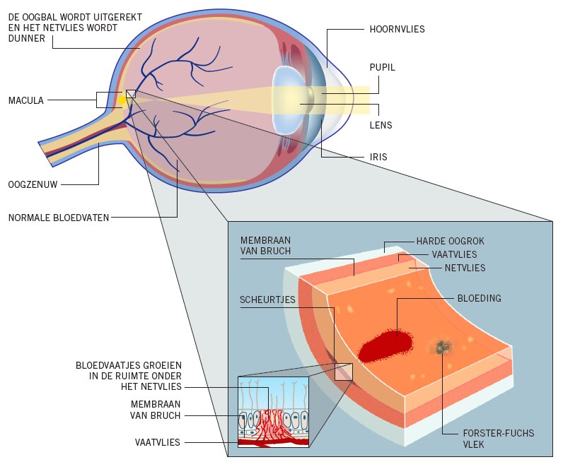 wat-is-myope-cnv